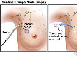 lymph node removal in early se