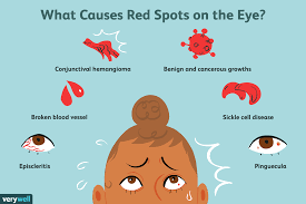 what causes a red spot on your eye