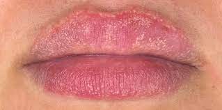fordyce spots lip blush cover