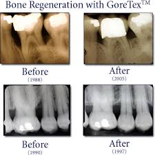 Both involve a breakdown and loss of bone tissue and connective tissue. Periodontal Treatment Mark J Sebastian D M D Practice Specializing In Periodontics And Dental Implants For Federal Way Wa