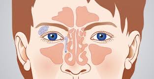 Eine sinusitis ist eine entzündung der nasennebenhöhlen. Nasennebenhohlen Op Nasenpolypen Nasenscheidewand Verkrummung