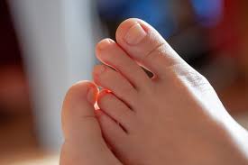 feet after a surgical nail removal