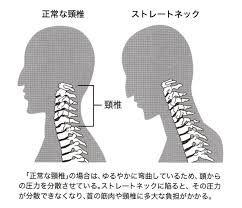 「首の痛み」の画像検索結果