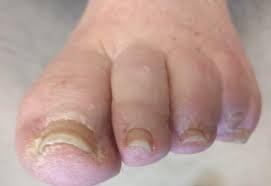 listerine for toenail fungus causes