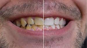 How to remove coffee stain on teeth. 10 Ways To Clean Yellow Teeth Naturally