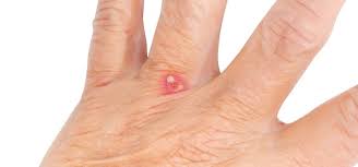 Know how to identify whitehead blisters and protect yourself from these very aggressive insects. Bites