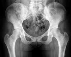 Systematic review three rings trace the main pelvic ring and two obturator foramina if a ring is disrupted, think fracture pelvis xr. Epos