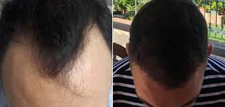 Please be realist is it unsuccessful hair transplant? Before And After Hair Transplant Step By Step Situation Rephair