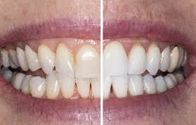 kör vs zoom teeth whitening stanley
