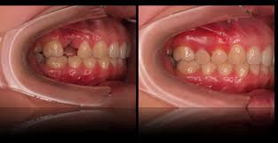 metal free partials and dentures