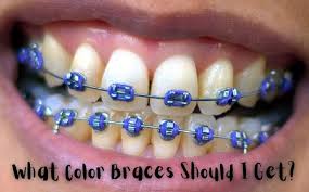quiz what color braces should i get