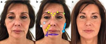 Facial Contouring by Using Dermal Fillers and Botulinum Toxin A: A  Practical Approach | SpringerLink