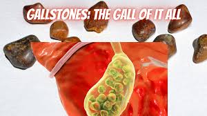 the gall of those gallstones how to