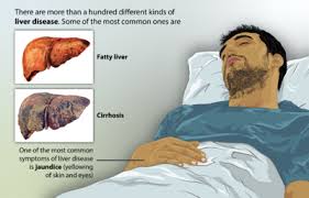 liver disease physiopedia