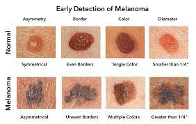 melanoma skin cancer types ses