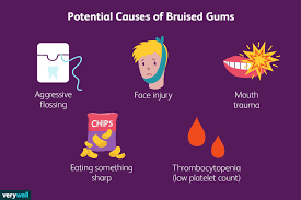 bruised gums causes diagnosis and
