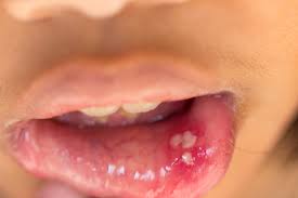 mouth ulcers embarring problems