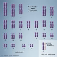 turner syndrome medlineplus genetics