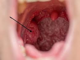 holes in tonsils causes symptoms and