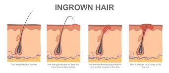 Ingrown hairs are baby hairs that are trying to break the surface of the skin — but somehow they just don't make it. 10 Ways To Prevent Pesky Ingrown Hairs Clio Style