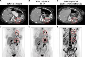 cancer is a group of diseases characterized by the uncontrolled growth and spread of abnormal cells. Major Cancer Regressions In Mesothelioma After Treatment With An Anti Mesothelin Immunotoxin And Immune Suppression Science Translational Medicine