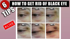 get rid of a black eye fast