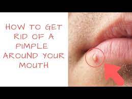 pimples around your mouth