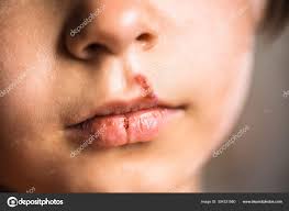 herpes on upper lip of little