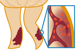 hemosiderin staining why your legs
