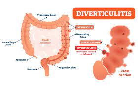 diverticulitis 10 home remes and