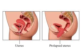 uterine prolapse east norriton women