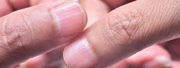what causes ridged nails treatements