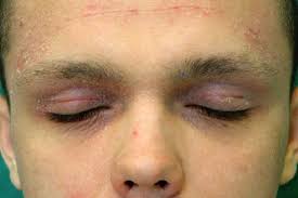 eczema around eyes causes symptoms