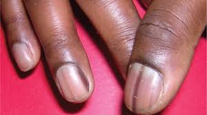 dark fingernails and vitamin deficiency