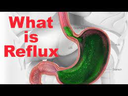 what is reflux or gerd lpr you
