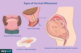 cervical effacement signs merement