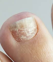 horizontal ridges on my toenail