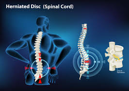 Herniated Disc Images – Browse 4,524 Stock Photos, Vectors, and Video |  Adobe Stock