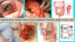 Intestinal Cancer | Intestinal Cancer Causes, Symptoms & Treatments |  Stages of Colon Cancer - YouTube