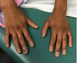 nail dystrophy and nail plate thinning