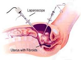 hysterectomy specialist in nyc