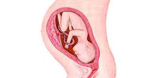 Most women possess about 1 to 4 consult a doctor if an increased quantity of wet discharge calls for the use of a pad or liner, as a pregnancy test can help to confirm your suspicions and a ride to your local midwife or obstetrician will. Pregnancy Week 36 Slightly Watery Virginal Discharge Than Normal