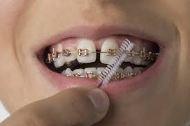 Teeth whitening is a popular solution to combat dental discoloration caused by drinking coffee, eating certain foods, smoking and the natural aging process. Preventing Tooth Decay While Wearing Braces Five Step Guide