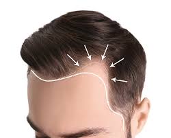 hair loss in men houston tx