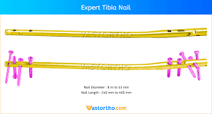 expert tibia nail uses sizes