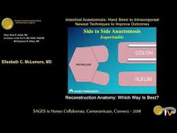 Colectomy with colocolonic, ileocolonic, or jejunocolonic anastomosis may be performed depending on the extent of the disease. Reconstruction Anatomy Which Way Is Best From The Sages Video Library
