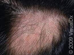 alopecia areata causes symptoms and