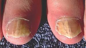 nail psoriasis pictures symptoms and