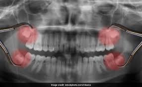 One of the large molars in the very back of the jaw. Easiest And Effective Home Remedies For Wisdom Tooth Pain