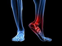 ankle sprain grades and corresponding